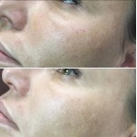 Обучение BB Glow и Микронидлинг (мезо процедуры под Дермапен