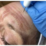 Plamon - многофункциональный Плазма аппарат (Plasma Pen)