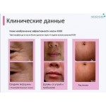 Карбокси терапия Riox NEO CO2 5 шприцов + 5 масок (лицо+шея)